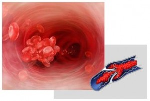 Bildung einer Thrombose in der Vene