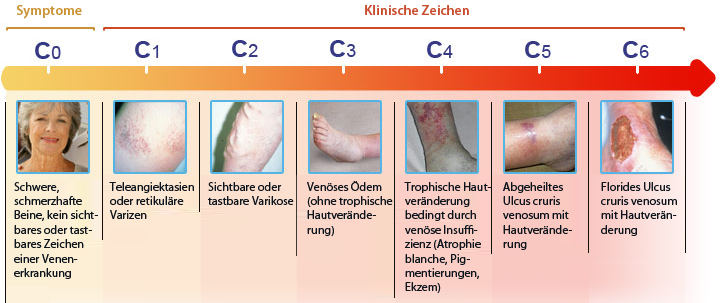 Chronisch Venöse Insuffizienz