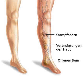 Das Postthrombotische Syndrom